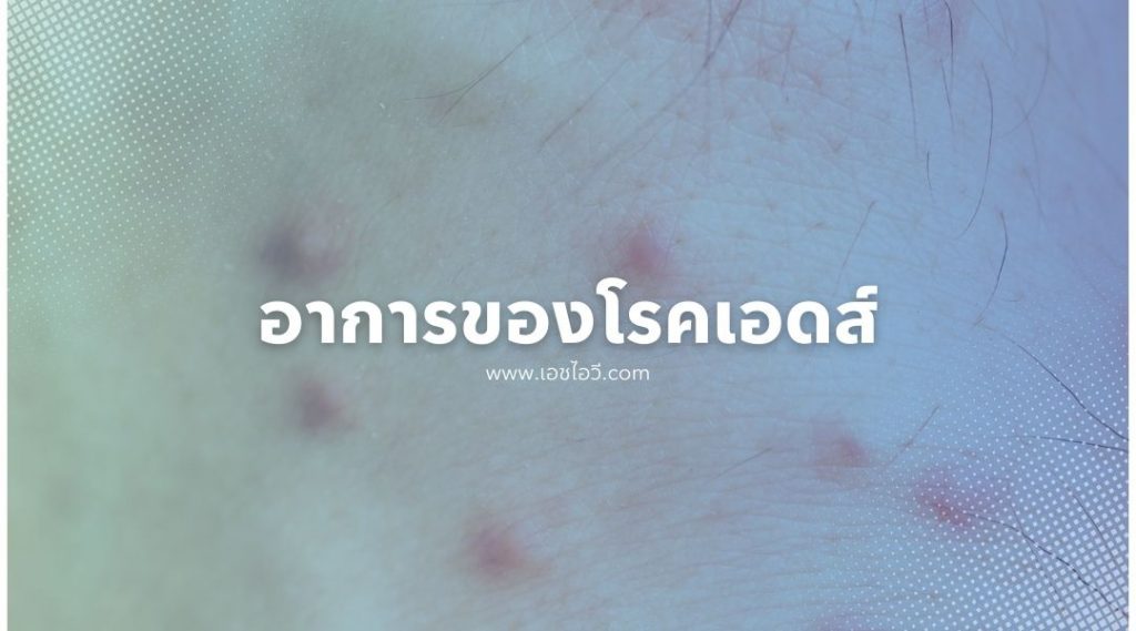 อาการของ โรคเอดส์