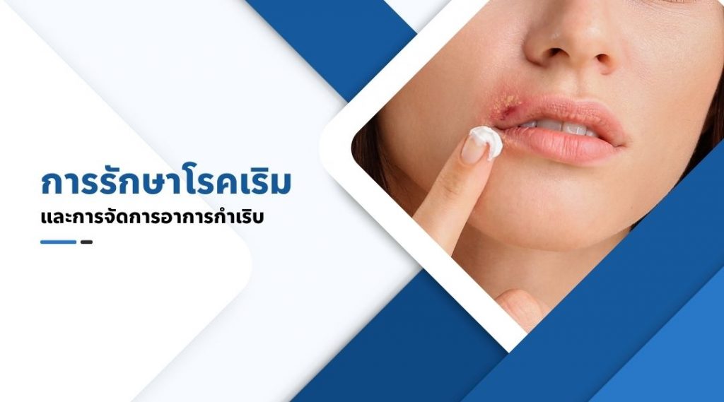 การรักษาโรคเริมและการจัดการอาการกำเริบ