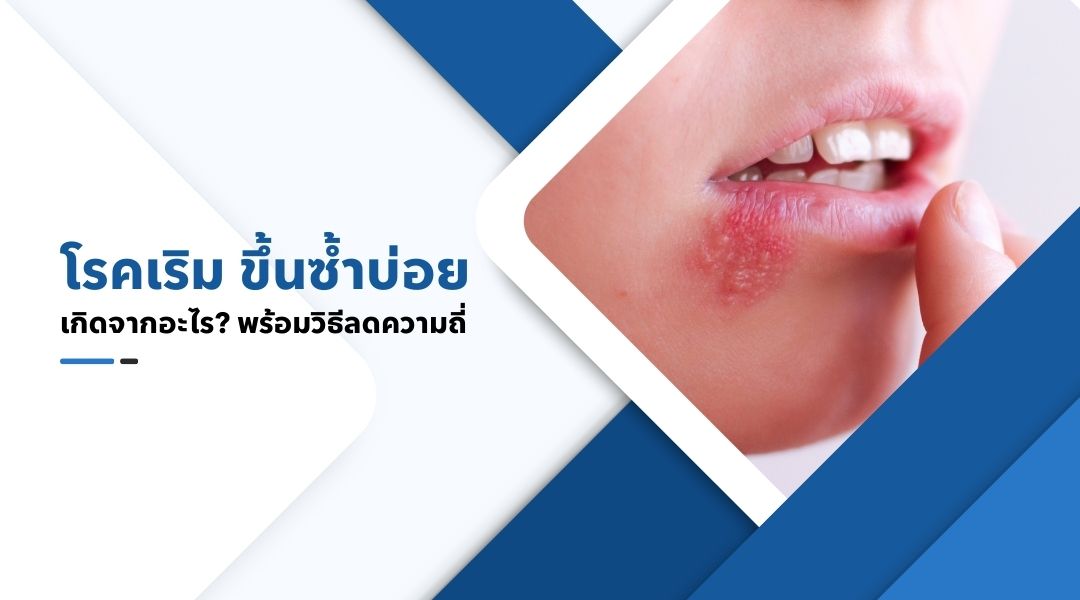 โรค เริม ขึ้นซ้ำบ่อย เกิดจากอะไร พร้อมวิธีลดความถี่